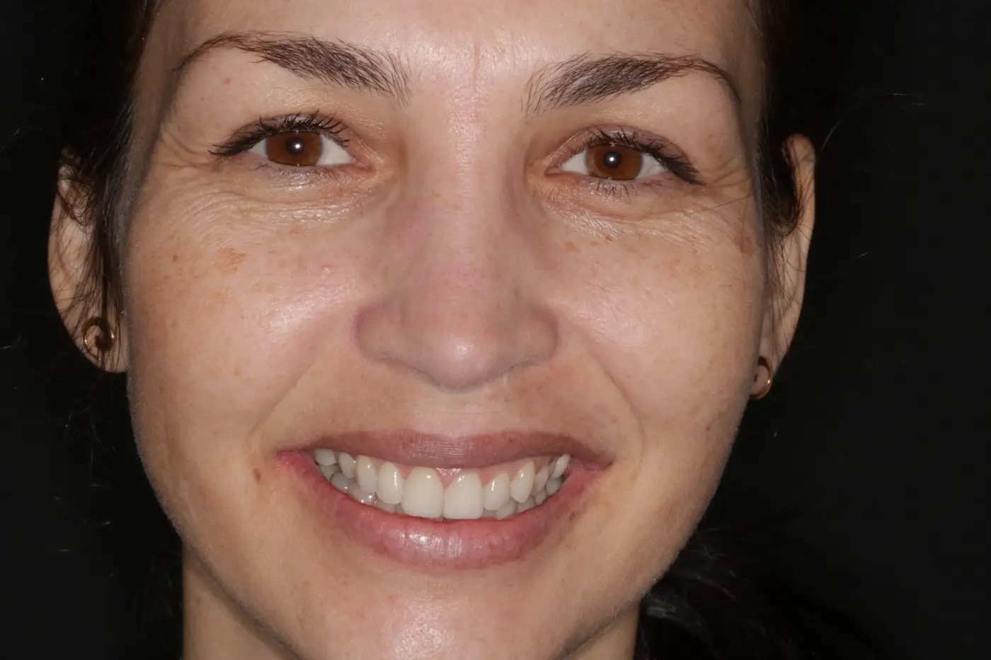 Paciente apresentando um sorriso natural